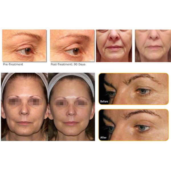 HIFU Beauty Equipment