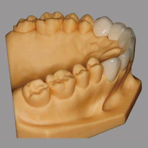 Aesthetic Porcelain Fused To Zirconia Bridge Hypoallergenic