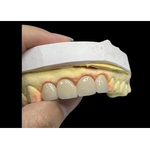 Advanced Translucency Ceramic Crowns and Bridges Enhance Your Smile with