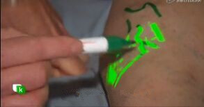 High Contrast Image Vein Light Vein Locator Device For Medical Puncture by
