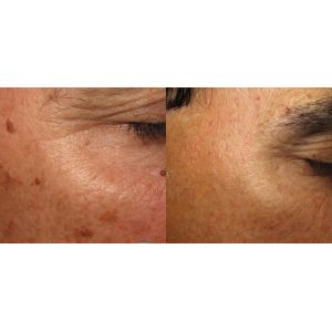 Multifunctional Q Switch ND Yag Laser Machine For Tattoo Removal / Pigmentation