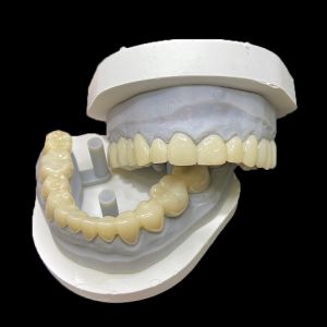 China PMMA Temporary Restorations CAD/CAM PMMA Crowns and Bridges for Provisional Dental Cases on sale