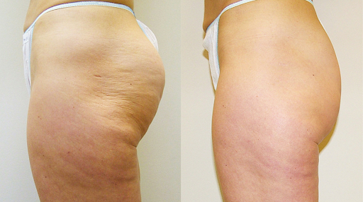 Endosferas 5D Vacuum Roller Infrared Body Shaper Slimming Machine