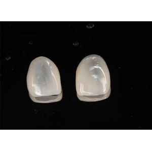 Aesthetic Restoration Emax Ceramic Veneers Translucency with Polished Surface