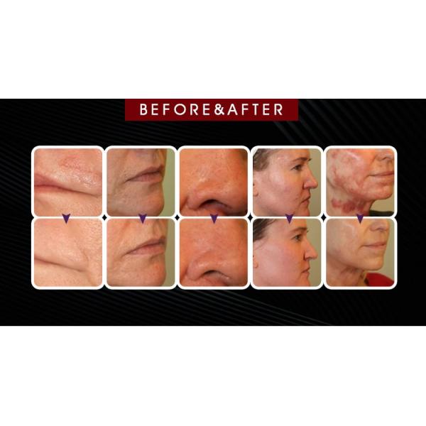 10600nm CO2 Fractional Laser Machine 6 Scan Modes For Wrinkles Removal