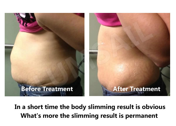 Cryolipolysis Weight Loss Equipment Slimming Machine