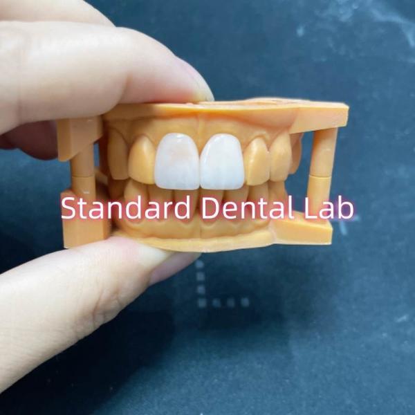 Quality High Colour Stability Ivoclar Emax Laminate Veneers High Translucency for sale