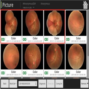 Hyper Static Non Mydriatic Fundus Camera Machine 180 Degrees