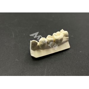 Hypoallergenic Stain-Resistant Emax Ceramic Inlay for Accurate Repair of Damaged