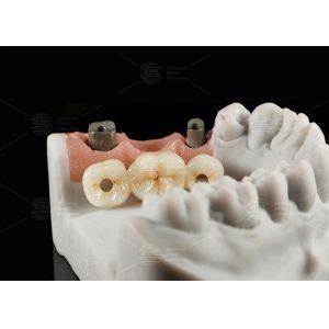 Screw Retained Titanium Custom Abutment Porcelain Fused To Zirconia