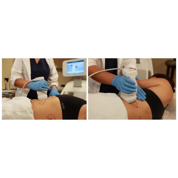 LF-431 Hifu fat removal/ Hifu Liposonic / Hifu Machine