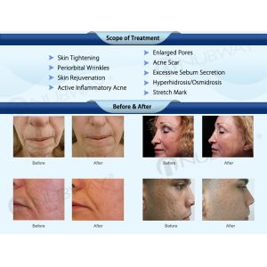 Hot selling face lifting Fractional RF Microneedle Machine