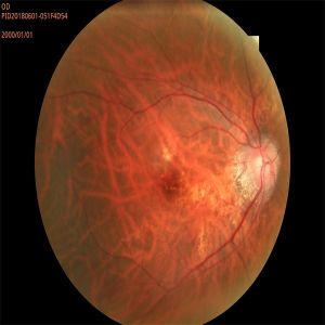 FDA Automated Fundus Camera 35mm Fluorescence Angiography