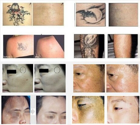 Skin Rejuvenation E Light Laser IPL Machine Equipment 2 In 1 Acne Treatment