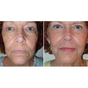 korea best rf stomach laser skin tightening stomach wave ferquency device