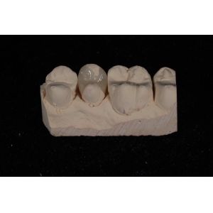 Strength Emax Ceramic Veneers Crown With Excellent Stain Resistance / Biocompati