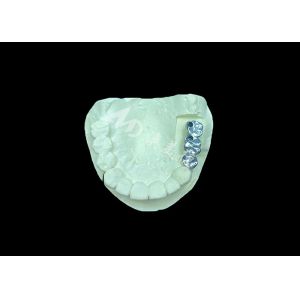 Long-lasting Full Cast Titanium Crown Dental Implant Molar For Missing Teeth