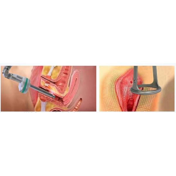 vaginal Co2 Fractional Laser Machine for vaginal tighten and skin rejuvenation