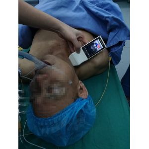 Wireless Linear Probe High Frequency Probe Special Tool for Visual Puncture