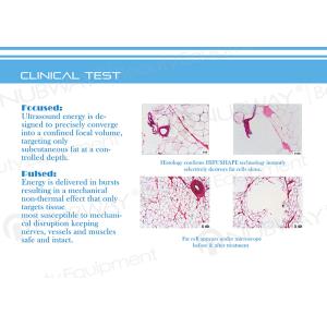 HIFU Body Fat Slimming! Newest Ultrashape Machine High Intensity Focused
