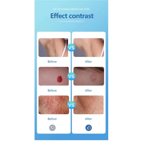 Two Wave Fractional Laser Machine , Picosecond Laser Device With 12 Inch Screen