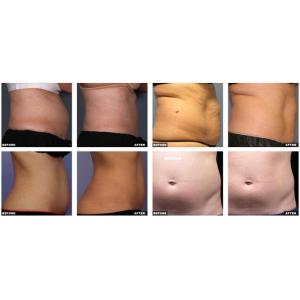 New Ultra Shape HIFU Fat Reducing Body Slimming Machine