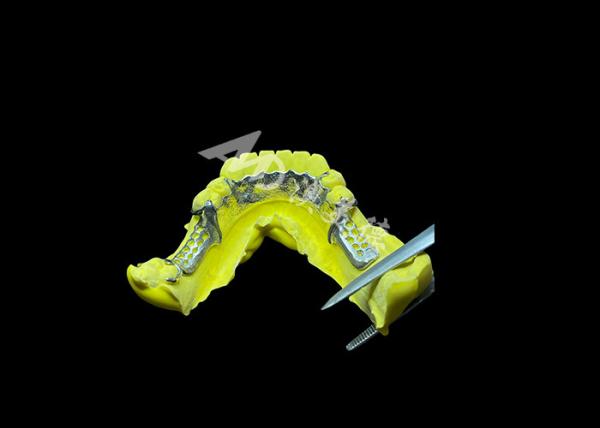 Quality Tailored Cast Partial Denture with Personalized Aesthetics and Secure Fit for Enhanced Comfort and Functionality for sale