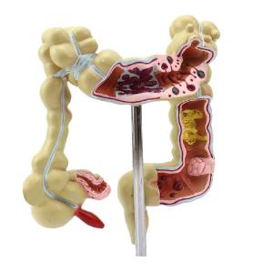 Colon Pathology 22.5cm Human Anatomy Model As Medical Teaching Learning Tool