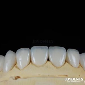 Glossy Surface Texture Feldspathic Veneer Natural Looking Porcelain Veneer