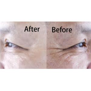 Hyaluronic Acid Filler Collagen Regeneration Whitening And Anti Aging Injection