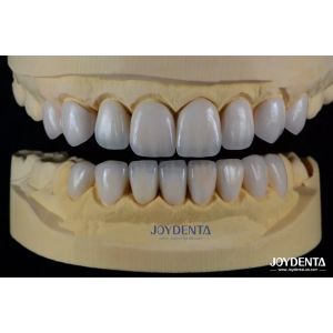 High Biocompatibility Feldspathic Ceramic Veneer Glossy For Dental Restorations
