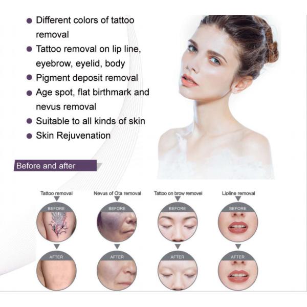 Q Switched ND YAG Laser Tattoo Removal Machine For Pigment Deposit Dispelling