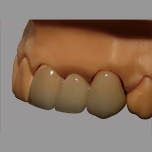 Biocompatible Full Ceramic PFZ Bridge With CAD / CAM System