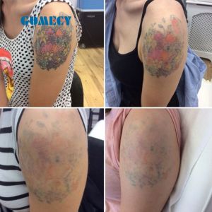 Q Switched ND Yag Laser Machine 2000W High Energy And 6 Functions 100-2000J For