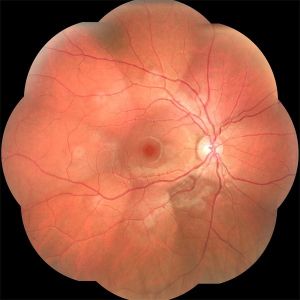 OCT Automated Fundus Camera High Resolution For Choroid