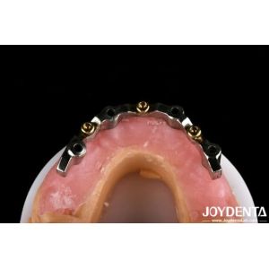 Silver Color Removable Dental Locator Attachments For Dentures Accurate Fit