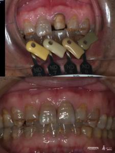 Translucency Zirconia Crowns Multilayered Gradient Technology For Optimal Translucency And Long-Term Biocompatibility