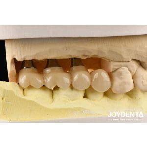 Ultra-precision processing Zirconia Implants All-Zirconium Integrated Crown