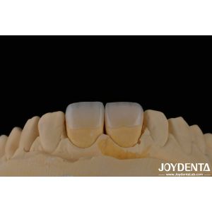 Long Lasting Dental Feldspathic Veneer Natural Tooth Color Translucent