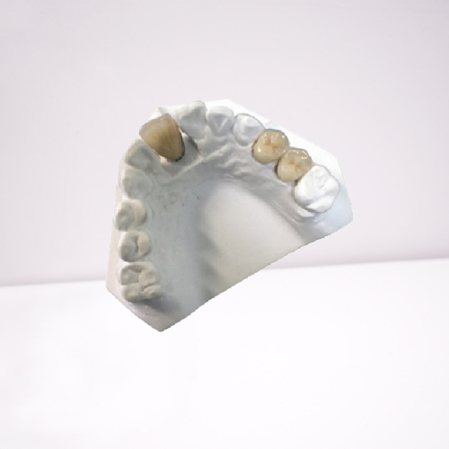 High Strength Porcelain Dental Bridge Yellow Gold Color New Condition