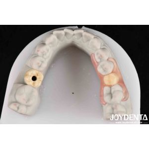 Flexible Denture Finish Personalized Customization and Advanced Tooth Arrangemen