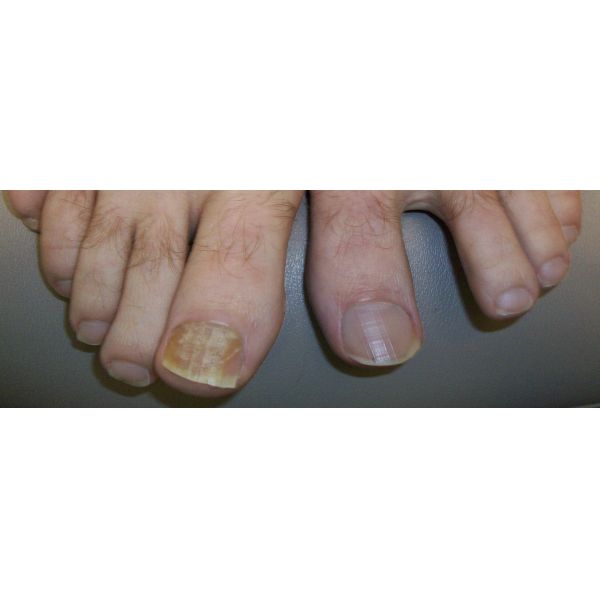 810nm 980nm Podiatry Laser