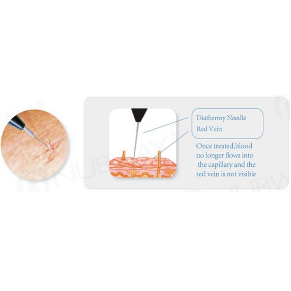 Immediately result spider vein removal varicose veins treatment machine / vascular surgical instruments