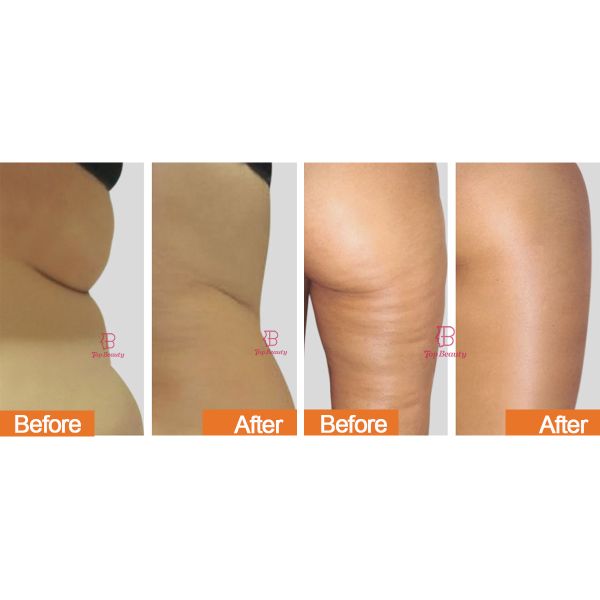7d Roller Therapy Anti Cellulite Roller Body Contouring Machine