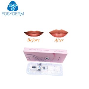2ml Derm Line Injectable Hyaluronic Acid Dermal Filler