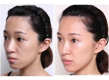 CE ISO certification 1ml deep Hyaluronic Acid dermal filler for Lips Filling