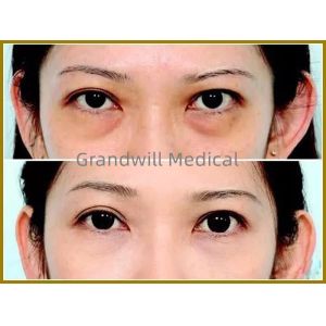 Injectable Sodium Hyaluronate Composite Solution Remove Dark Circles Fill Tear