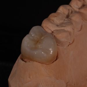 Full Contour Translucent Zirconia Crown for Aesthetically Pleasing Results