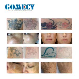 Picosecond Yag Laser Machine 1064nm 532nm 755nm 1320nm Pigmentation Laser