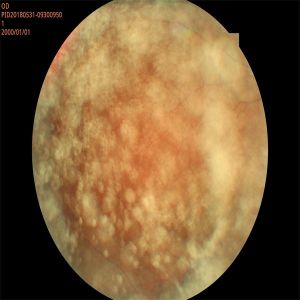 FDA Automated Fundus Camera 35mm Fluorescence Angiography